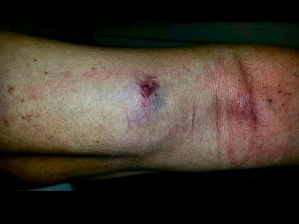 Arm showing skin bruising and inflammation medical documentation