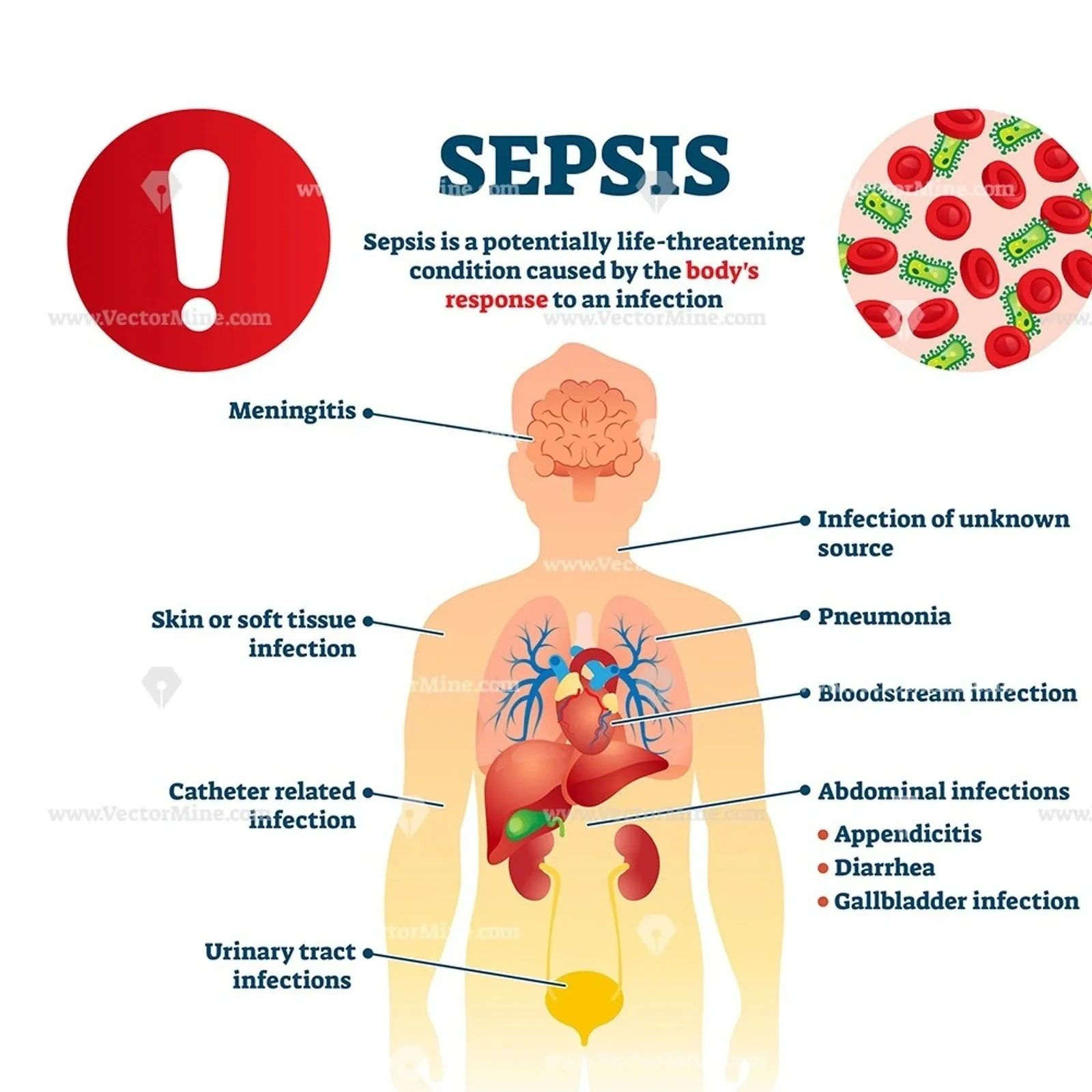Sepsis medical infographic body diagram showing infection sources