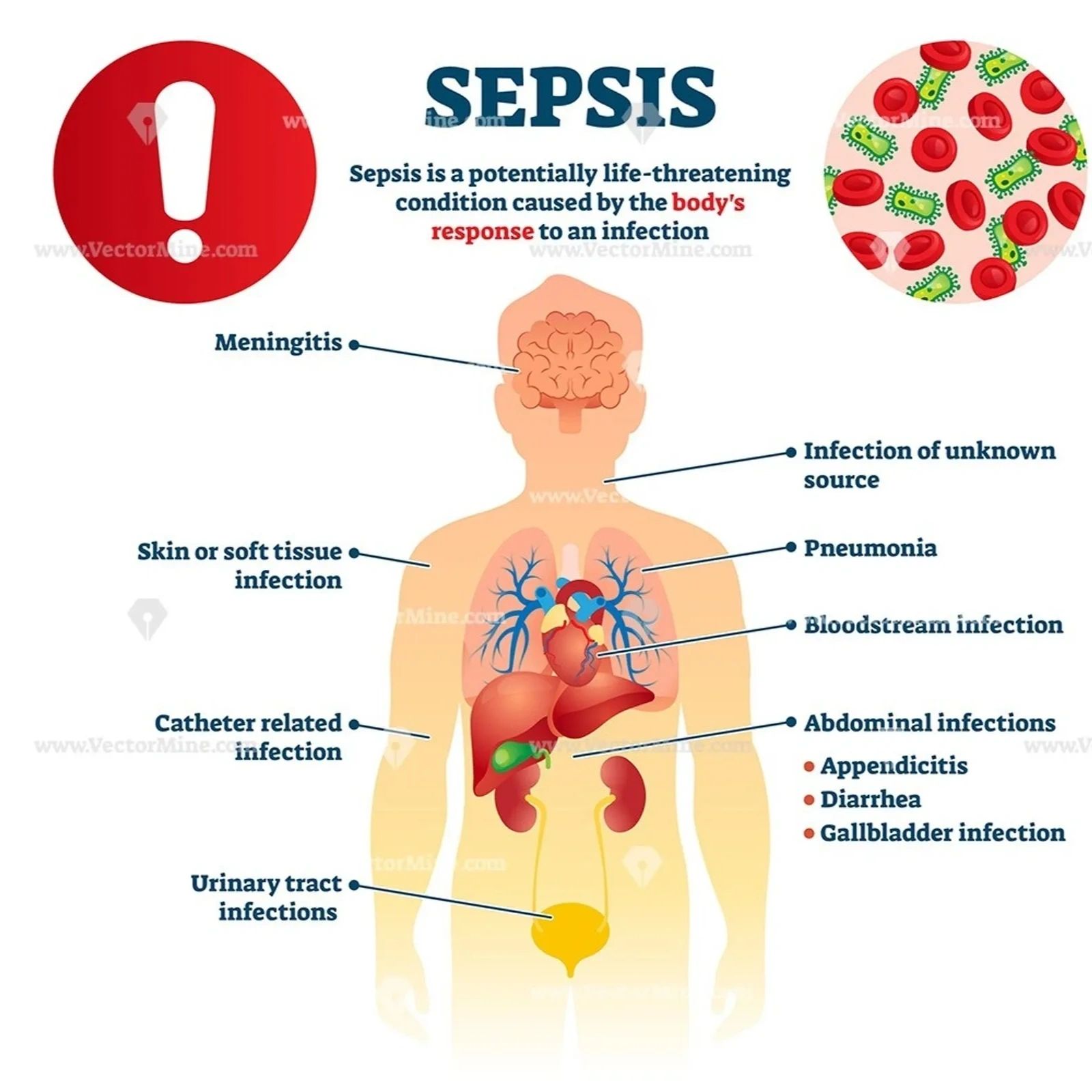 WHO infographic: What is sepsis — life-threatening illness that injures tissues and organs